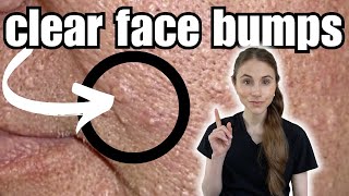 How To Clear And Prevent Face Bumps  Sebaceous Hyperplasia [upl. by Louanna]