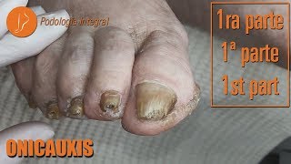 Onicauxis onychomycosis amp callosities Part 1 podologiaintegral [upl. by Oned]