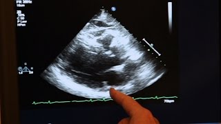 Echocardiogram Demonstration [upl. by Nosnej]