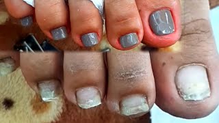 Satisfying Ingrown Toenail Removal  Dry Skin  Pedicure 117 [upl. by Iliram]