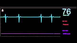 1 Arritmia sinusal [upl. by Cheke]