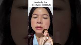 Melasma Cream 40 Off Today [upl. by Meelak969]