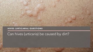 Can hives urticaria be caused by dirt [upl. by Harlen845]