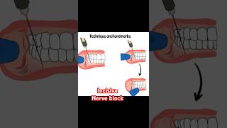 Incisive nerve block [upl. by Ahtibat]