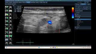 IQ 309 MESENTARY LN ENLARGEMENT ASCITES BLOOD LYMPHOMA ULTRASOUND COLOR FLOW MAP DOPPLER MODE [upl. by Eyanaj]