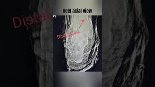 calcaneus axial viewLateralobliqueheel axial view created by techno gauravgauravtechnologist [upl. by Feinleib]