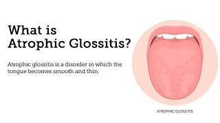 Atrophic Glossitis  Inflammation of the tongue  Causes Types Syptoms and Treatment [upl. by Hesper]