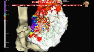 BRUGADA SYNDROME ABLATION WITH ENSITEX amp OT TECHNOLOGY [upl. by Yhtrod]