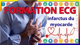 ECG de linfarctus du myocarde [upl. by Letrice]