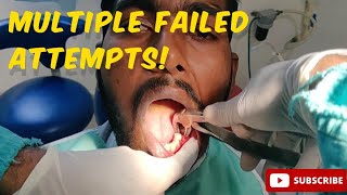 Painless Extraction of Infected amp Broken Molar Tooth dental youtubevideo wisdomteeth viralvideo [upl. by Nolyarb]