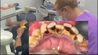 Dental cleaning  scaling teeth removing smoker’s tartar [upl. by Nagy37]