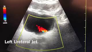 Hydronephrosis and Ureteral Jets [upl. by Gerhardine76]