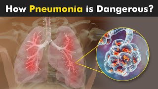 What Happens in Pneumonia  Symptoms Causes and Treatment 3D Animattion [upl. by Nibas239]