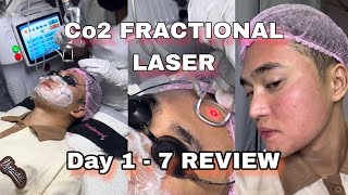 CO2 Fractional Laser Review DAY 1  7 [upl. by Babette367]