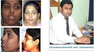 ARPITA SHEULI DASDR ANIRVAN SENGUPTAS PATIENTs INTERVIEW AFTER TREATMENT [upl. by Aramit]