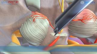 Animation MultiZYTE RT – Facet Denervation [upl. by Enelahs]