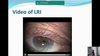 Overview of Astigmatism Management during Cataract Surgery [upl. by Analiese591]