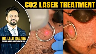 co2 fractional  laser treatment for acne scars  DrLalit Kasana [upl. by Lien]