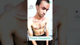 Tinea Corporis  Testimonial  Dhaka Dermatology Institute [upl. by Amery]