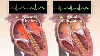 What is Atrial Fibrillation Chapter 1 HRS Patient Video [upl. by Anthea304]