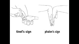 Phalens Sign or Test  Definition Procedure Results Differences with Tinels Sign [upl. by Pickens249]