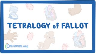 Tetralogy of Fallot Year of the Zebra [upl. by Kipper227]