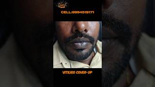 Vitiligo vitiligo lips vitiligo causes vitiligo treatment vitiligo hospital vitiligo skin [upl. by Lenora]