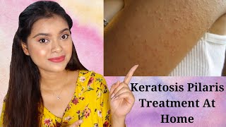 Chicken Skin Treatment  Keratosis Pilaris Treatment at Home  How to Treat Rough and Bumpy Skin [upl. by Emyam]