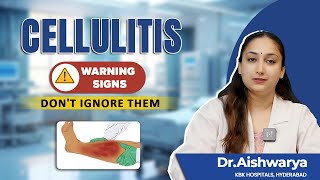 Cellulitis Alert  Dont Ignore These Cellulitis Symptoms  Dr Aishwarya  KBK Hospitals [upl. by Risteau]