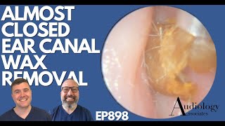 ALMOST CLOSED EAR CANAL WAX REMOVAL  EP898 [upl. by Latsirk319]