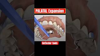 PALATAL EXPANDER  Expansion of upper jaw after several weeks [upl. by Nyleuqcaj]