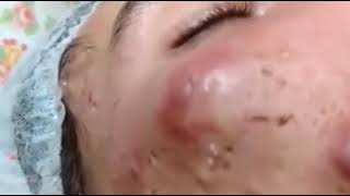 Big Acne Pus on face pop out Really hurt and terrified [upl. by Petit]