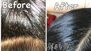 Remove 100 Lice amp Eggs Permanently with Hair Sheild Anti lice Cream 49 Rs  Farha KHan [upl. by Schaeffer936]