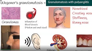 Wegeners granulomatosis  Granulomatosis with polyangiitis  Symptoms and causes [upl. by Kindig]