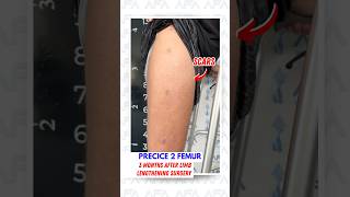 3 MONTHS AFTER LIMB LENGTHENING SURGERY Precice 2 Femur limblengtheningsurgery heightincrease [upl. by Resay873]