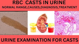 RBC CAST IN THE URINE CAUSES SYMPTOMS AND TREATMENT OF RBC CAST IN URINE EXAMINATION [upl. by Atiram]