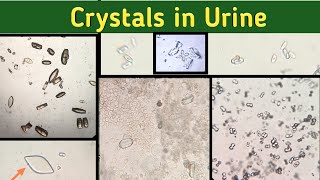 Identify Urine crystals  Crystals in Urine under Microscope  Urine Microscopic Examination [upl. by Soo898]