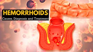 Hemorrhoids or Piles CausesSigns and symptoms Diagnosis and Treatment [upl. by Tierney]