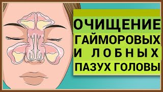 ЧИСТКА ГАЙМОРОВЫХ И ЛОБНЫХ ПАЗУХ ГОЛОВЫ [upl. by Fisoi]