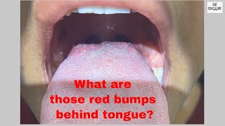 What are Red bumps behind Tongue  Taste Buds How to keep them clean and healthy [upl. by Rumery]