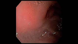 Normal oesophagogastroduodenoscopy [upl. by Parrie]