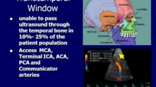 Transcranial Doppler [upl. by Ahseikan]