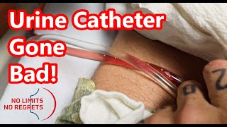 Urinary CATHETER PROBLEMS  Heart Surgery Gone Bad amp Problem with Catheter [upl. by Gabriell]