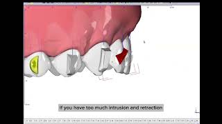 PIR protocol for CII div 2  procline intrude retract with Onyxceph [upl. by Cirded397]