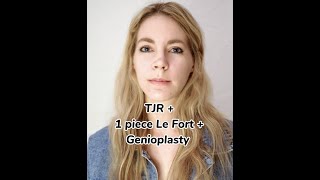 2 Week Postop Update TJR  1 piece Le Fort  Genioplasty [upl. by Boj]