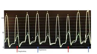 Hemodynamics Constrictive pericarditis cases mechanisms technical tips Elias Hanna Univ of Iowa [upl. by Anahsed897]