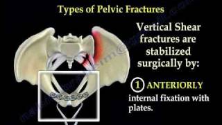 Pelvic Fracture Overview  Everything You Need To Know  Dr Nabil Ebraheim [upl. by Azilef]