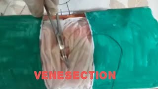 Venesection basic surgical procedure Theraputic thrombectomy Emergency procedure [upl. by Lalo]