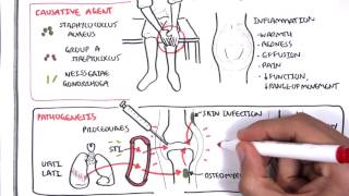 Septic Arthritis  Overview causes pathophysiology treatment [upl. by Sill]