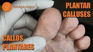 Plantar calluses Podología Integral podologiaintegral [upl. by Valda]